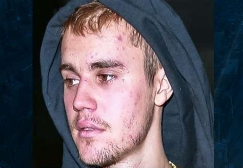 justin bieber calvo|doença de lyme justin bieber.